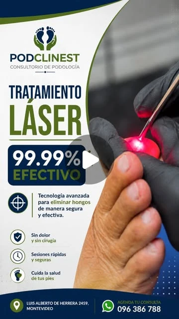 Miniatura de Instagram sobre tratamiento láser para uñas con hongos