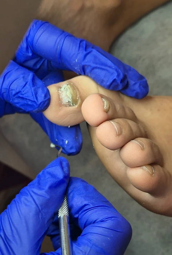 Cuidado profesional de las uñas de un paciente